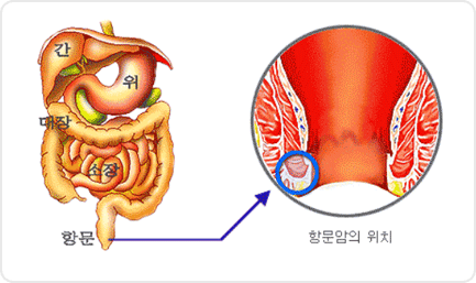 항문암